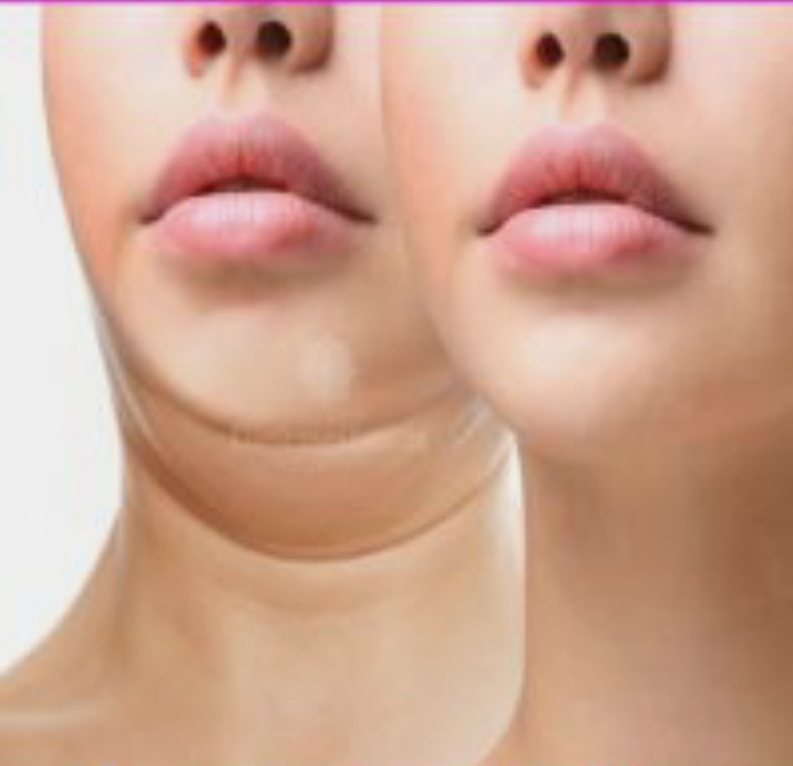 LIPOSUCCION DE PAPADA O LIPECTOMIA SUBMENTAL 